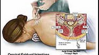 Epidural steroid injections for disc prolapse