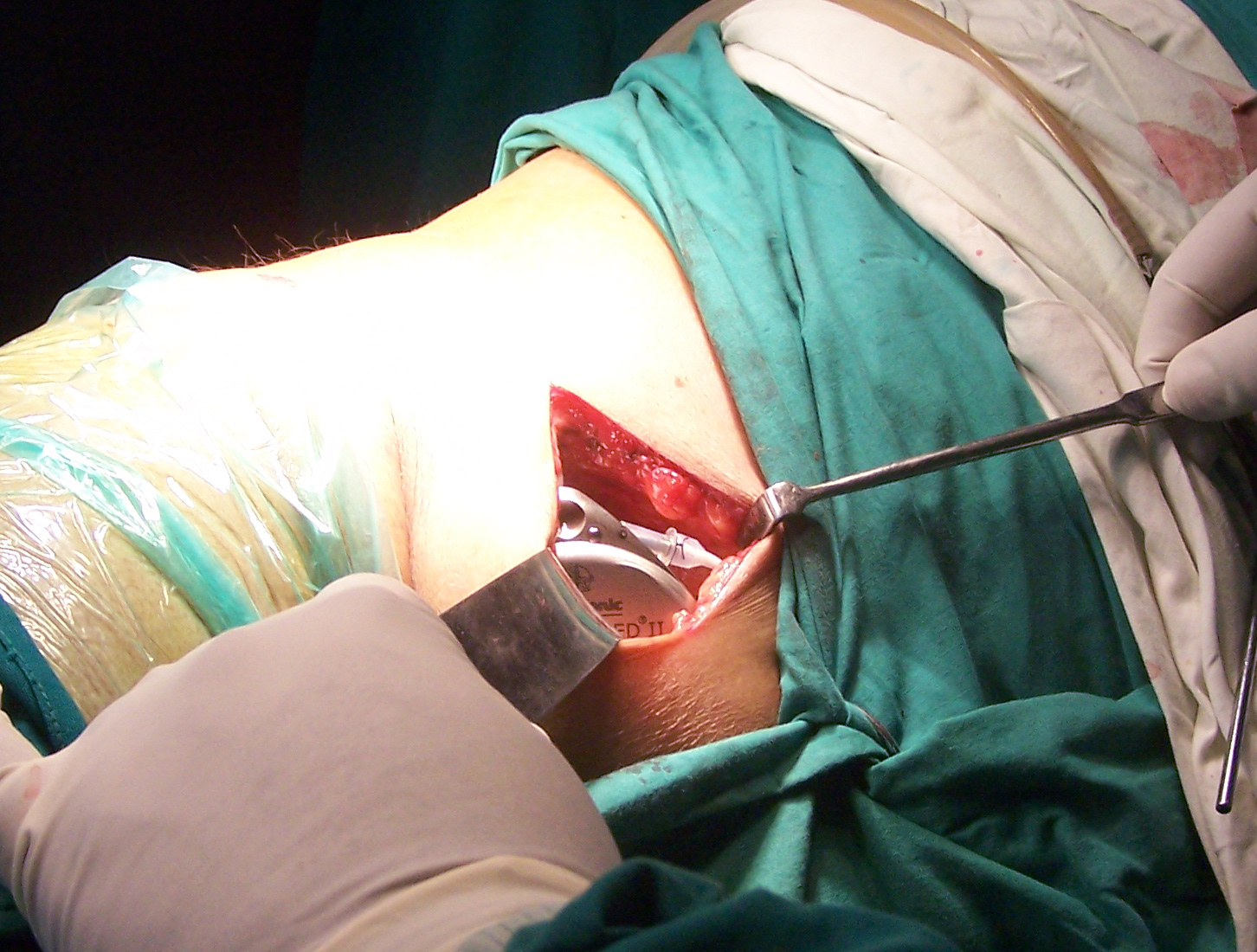 Baclofen Pump Insertion