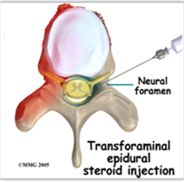 Neuroforamen