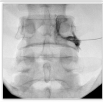  Lumbar Epidural Steroid