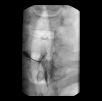 Cervical Epidural