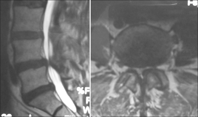 Lumbar Canal Stenosis