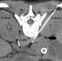 Celiac Plexus Block