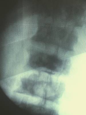 b2ap3_thumbnail_IMG_4971.JPG percutaneos vertebroplasty medication