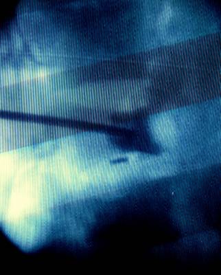 b2ap3_thumbnail_IMG_4973.JPG percutaneos vertebroplasty treatment