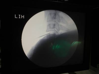 b2ap3_thumbnail_IMG_67371.JPG Under Local anesthesia Needle in the middle of the disc