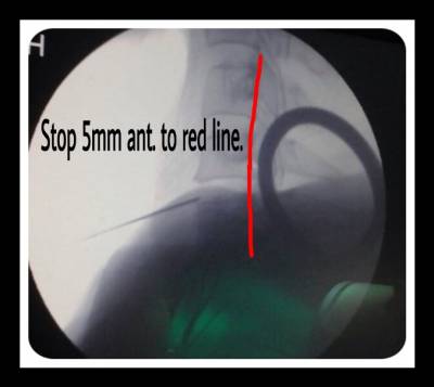 b2ap3_thumbnail_IMG_67401.JPG neck pain treatment procedure
