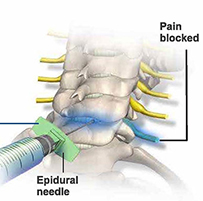 Implanted epidural portal