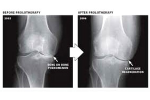 Proliferative therapy treatment