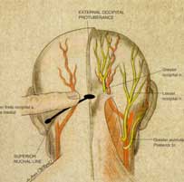 Occipital nerve block