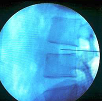 Disc procedure - ozone necleolysis