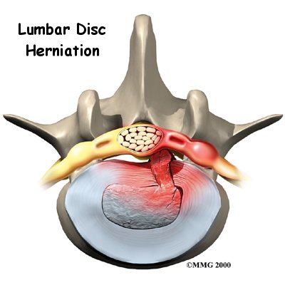 Provocative lumbar discography