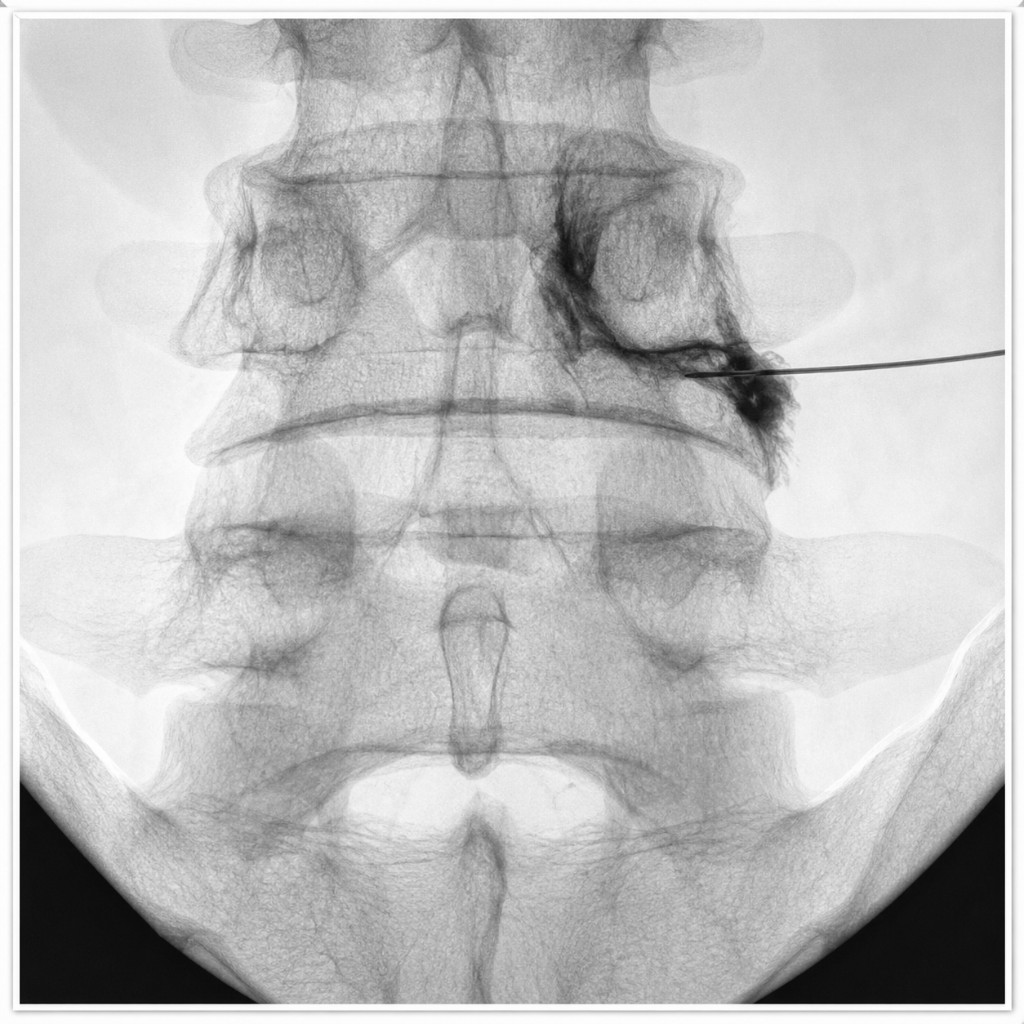 Lumbar epidural steroid injection fluoroscopy image