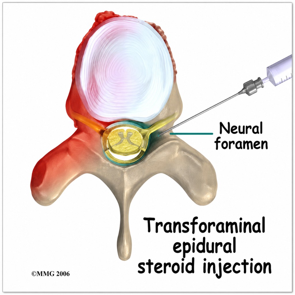 Transforaminal epidural steroid injection near neural foramen