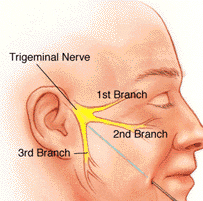 gasserian ganglion rf ablation reference image