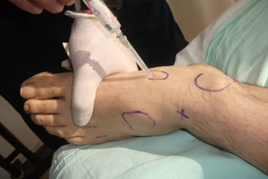 prolotherapy reference image