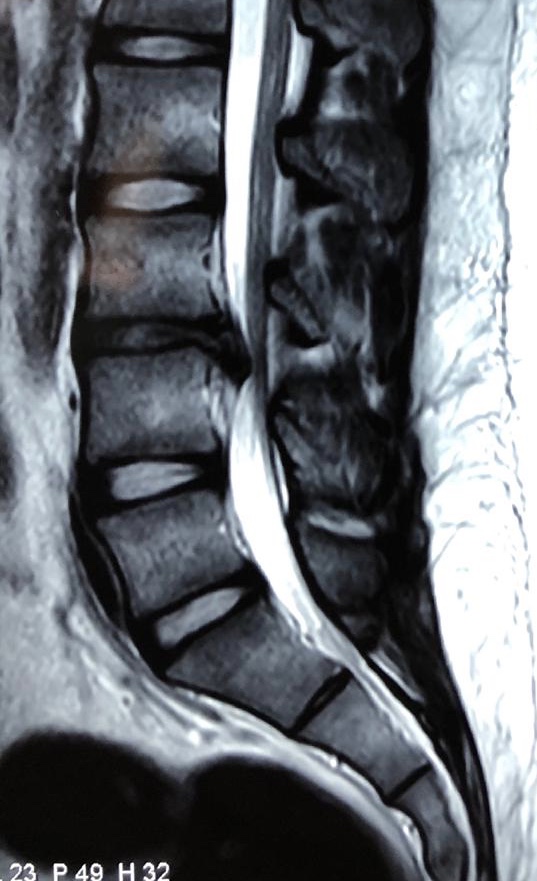 transforaminal endoscopic discectomy reference image