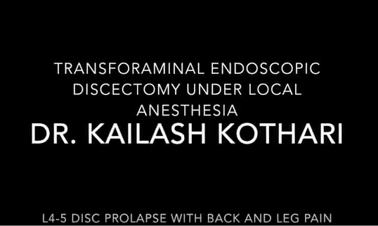 transforaminal endoscopic discectomy reference image