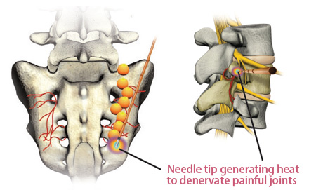 sacroiliac joint pain treatment