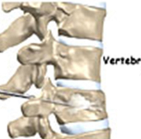 Percutaneous Vertebroplasty