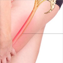 Sciatica treatment