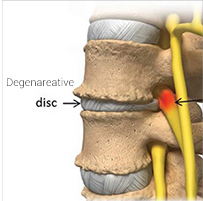 Degenerative spine disease