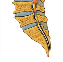 Lumbar canal stenosis